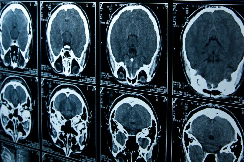 Utah Brain Injuries Lawyer